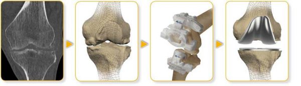 Knee Surgery Sydney